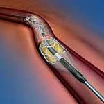cordis corporation stents